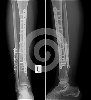 X-ray Fracture of both bones of the left shin with metal construction.