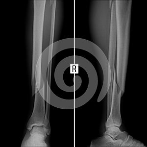 X-ray fracture of both bones of the right shin.