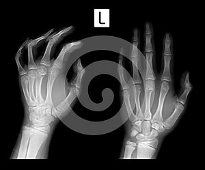 X-ray Fracture of metaphysis 3 of metacarpal bone.