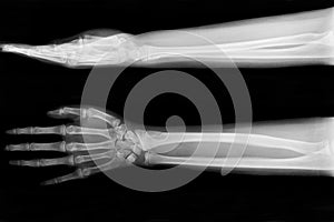 X-ray fracture ulnar bone