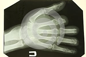 X-ray front picture of the palms