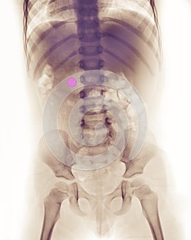 X-ray of a girl who swallowed a battery