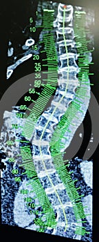 X-ray green scale of scoliosis pathological curvature