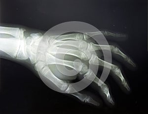 X-ray hand