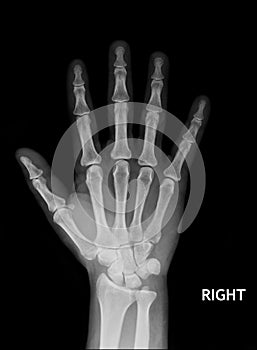 X-Ray of Hand.