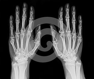 X-Ray of Hand.