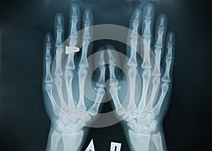 X-ray hand (finger)