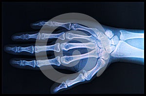 X-ray of Hand and fingers photo
