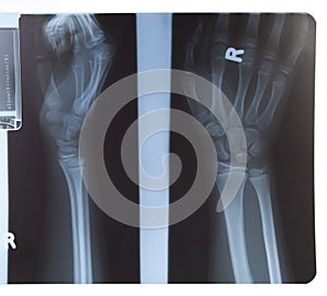 X-ray of hand and forearm photo