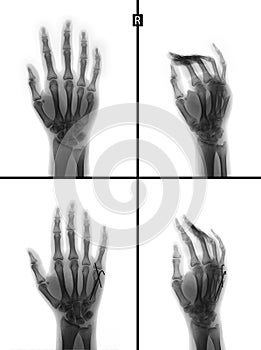 X-ray of the hand. Fracture of the 5rd metacarpal bone. Reposition. Osteosynthesis. Negative.