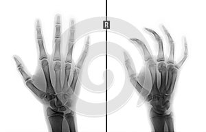X-ray of the hand. Fracture of the 3rd metacarpal bone the child. Negative. photo