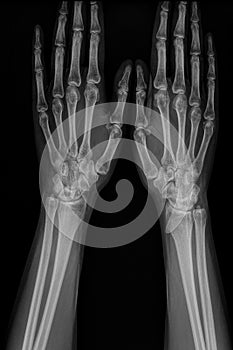 X-ray hand of man with arthritis