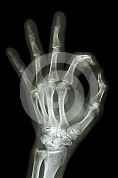 X-ray hand with OK symbol