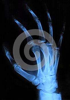 X-ray hand