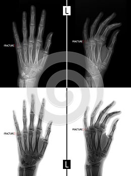 X-ray of the hand. Shows the Fracture of the base of the proximal phalanx of the fifth finger of the left hand. Marker. Positive.