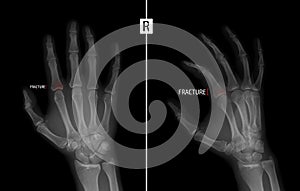 X-ray of the hand. Shows the Fracture of the base of the proximal phalanx of the second finger of the right hand. Marker. Negative