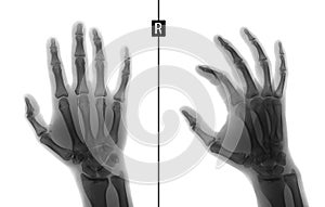 X-ray of the hand. Shows the Fracture of the base of the proximal phalanx of the second finger of the right hand. Marker. Negative