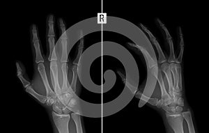 X-ray of the hand. Shows the Fracture of the base of the proximal phalanx of the second finger of the right hand. photo