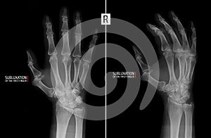 X-ray of the hand. Shows the subluxation of the proximal phalanx of the first finger of the right hand. Marker. photo