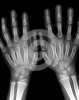 X-ray hands