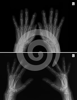 X-ray of hands. Arthritis-arthrosis.