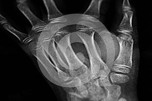 x-ray of the hands, detail of the phalanges and joints,trapeze,scaphoid,Pyramidal,Pisiform,capitate, distal, frontal, proximal, photo