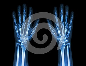 X-Ray Hands ( front view ) : Normal human hands