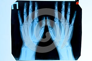 X ray of the hands, a picture of the bones of the hands on the x-ray