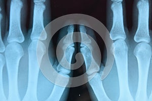 X ray of the hands, a picture of the bones of the hands on the x-ray