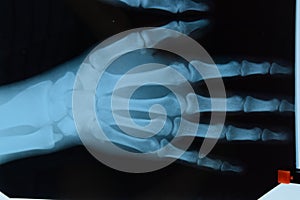 X ray of the hands, a picture of the bones of the hands on the x-ray