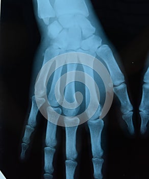 X ray of the hands, a of the bones of the hands on the x-ray