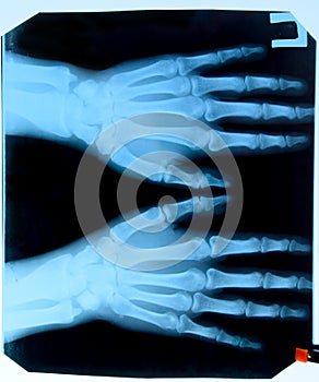 X ray of the hands, a of the bones of the hands on the x-ray
