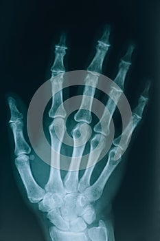 X-ray of the hands. Real x-ray picture of a hand with fingers. At the doctorÃ¢â¬â¢s appointment, hospital. photo