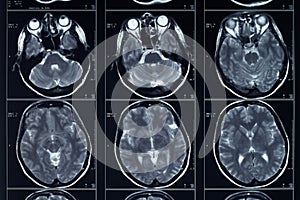 X-ray head and brain radiography