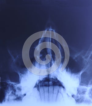 X-ray of head: Sinusitis photo