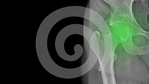 X-ray of a healthy hip in a man`s left hip joint in the green area, walking easily, requires gymnastics and healthy nutrition