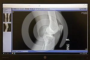 X-Ray of a healthy knee bone on a computer screen