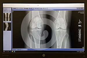 X-Ray of 2 healthy knee bones on a computer screen