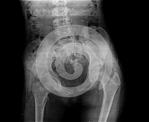 X-ray of hip