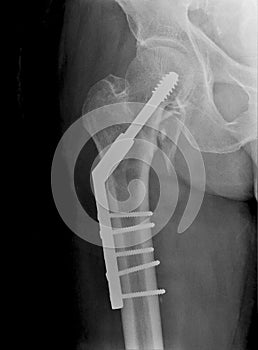 X-ray Hip AP