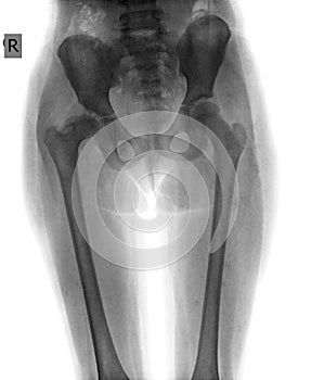 X-ray of hip child