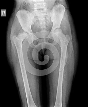 X-ray of hip child
