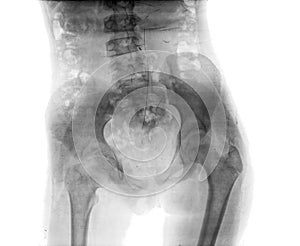 X-ray of hip