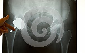 X-ray of a Hip Prosthesis