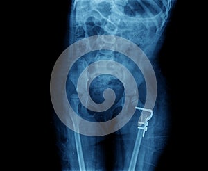 X-ray of hip prosthesis