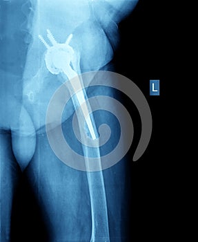 X-ray of hip prosthesis