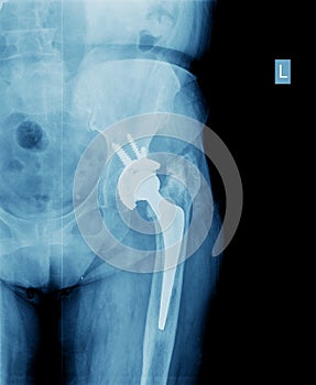 X-ray of hip prosthesis photo