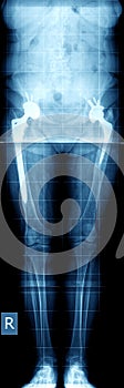 X-ray of hip prosthesis