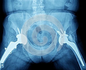 X-ray of hip prosthesis