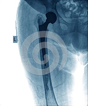 X-ray of hip prosthesis